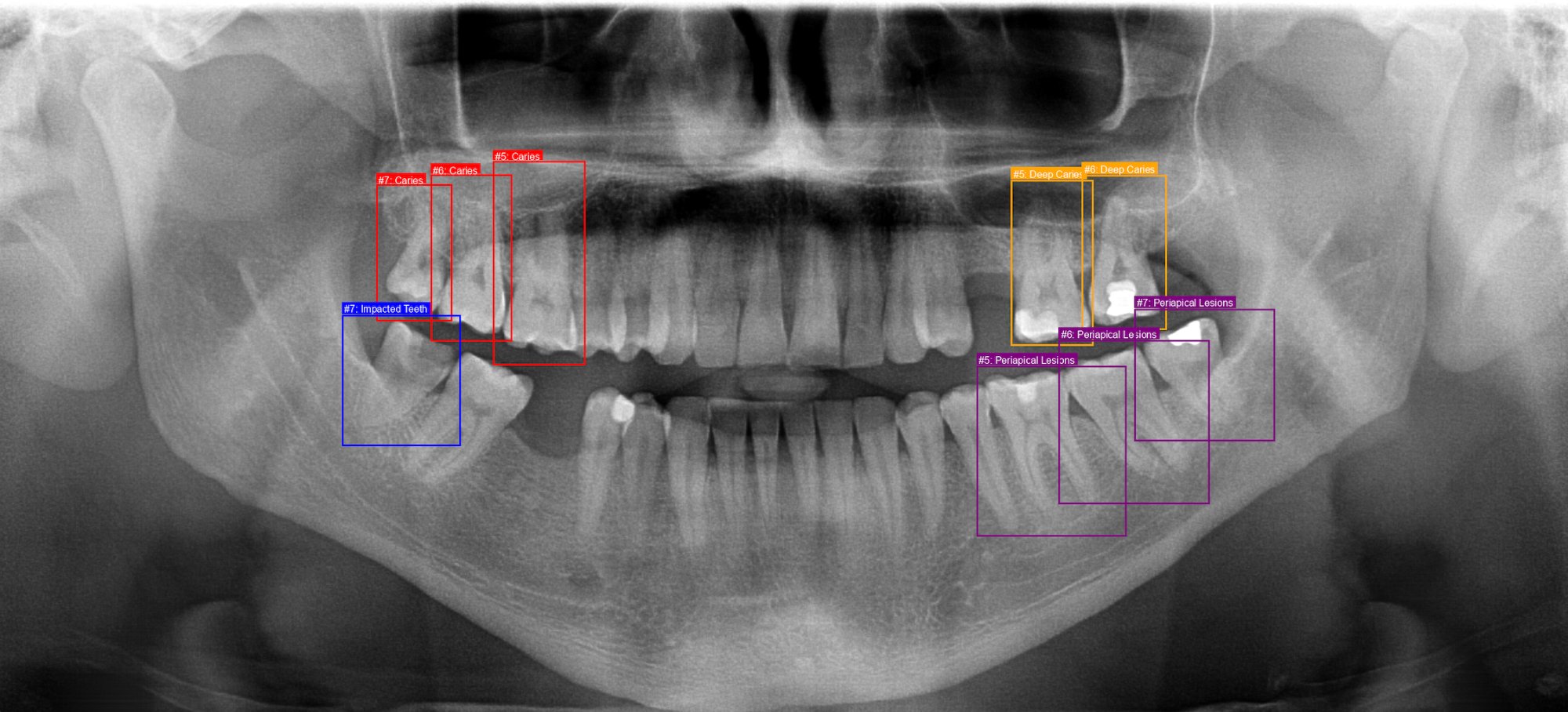 Annotated panoramic dental X-ray showing caries detection, impacted teeth identification, and periapical lesion detection with color-coded bounding boxes